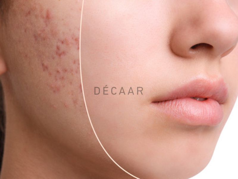 Hiệu quả peel da